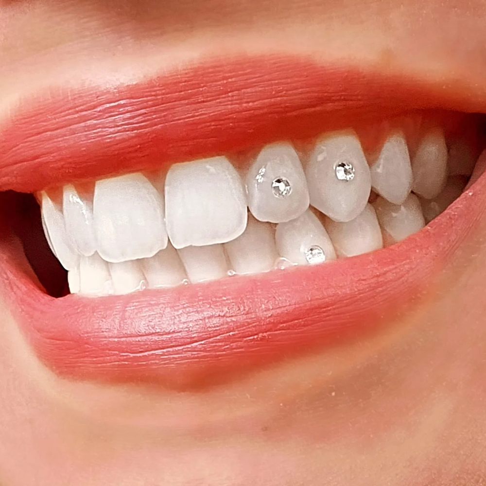 Tooth Gems   Delicately applied crystal or gold gems that enhance your smile with sparkle and personality — safe, stylish, and fully reversible.   Learn More